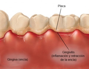 Que es la Gingivitis - Clinica El Dentista